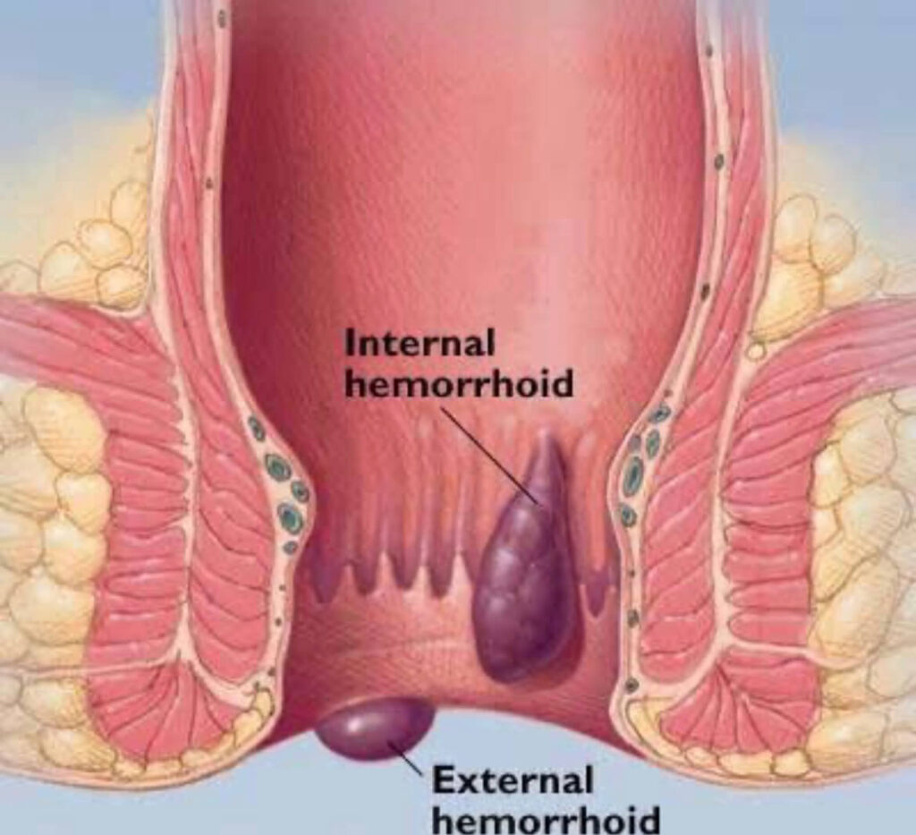 Best Hemorrhoids Treatment in bangalore