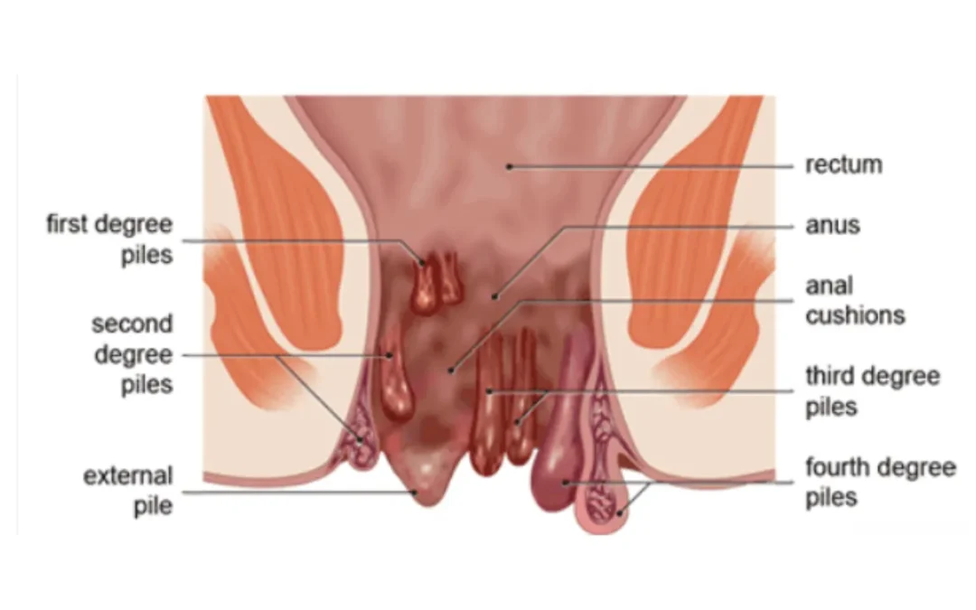 Understanding Everything you need to know about Hemorrhoids(Piles)