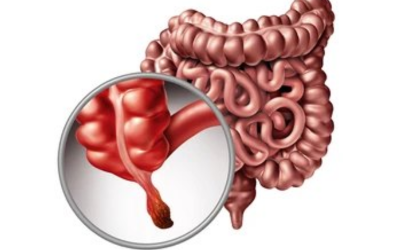 Appendicitis