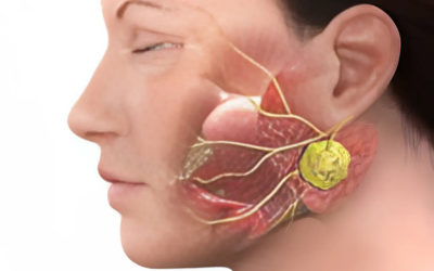 Parotid_Lesions