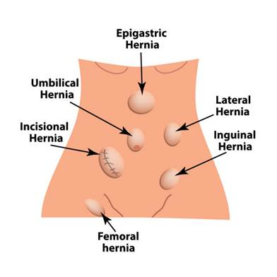 Types of Hernia treated by Dr. Rajeev Premnath 