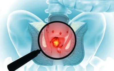 Piles_(Haemorrhoids)