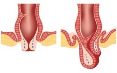 Rectal_Prolapse