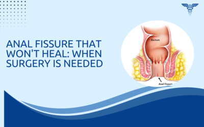 Anal Fissure That Won’t Heal: When Surgery Is Needed