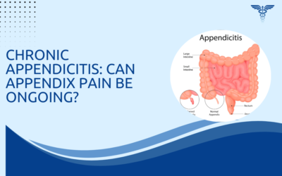 Chronic Appendicitis: Can Appendix Pain Be Ongoing?
