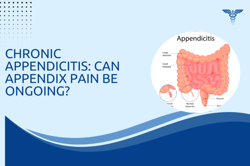 Chronic Appendicitis: Can Appendix Pain Be Ongoing?