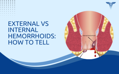 External vs Internal Hemorrhoids: How to Tell