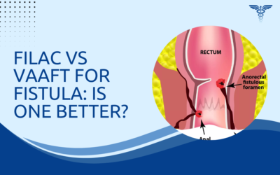 FiLaC vs VAAFT for Fistula: Is One Better?