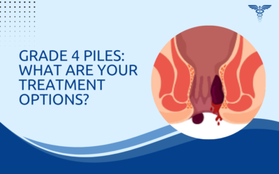Grade 4 Piles: What Are Your Treatment Options?