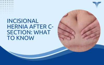 Incisional Hernia After C-Section: What to Know