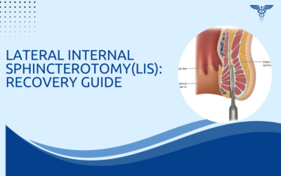 Lateral Internal Sphincterotomy (LIS): Recovery Guide.
