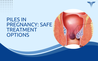 Piles in Pregnancy: Safe Treatment Options
