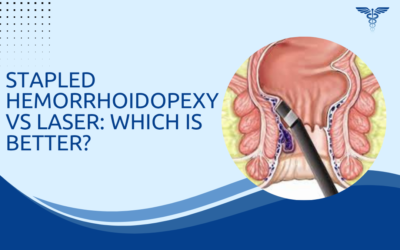 Stapled Hemorrhoidopexy vs Laser: Which Is Better?