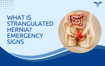 What Is Strangulated Hernia? Emergency Signs