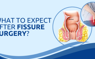 What to Expect After Fissure Surgery?