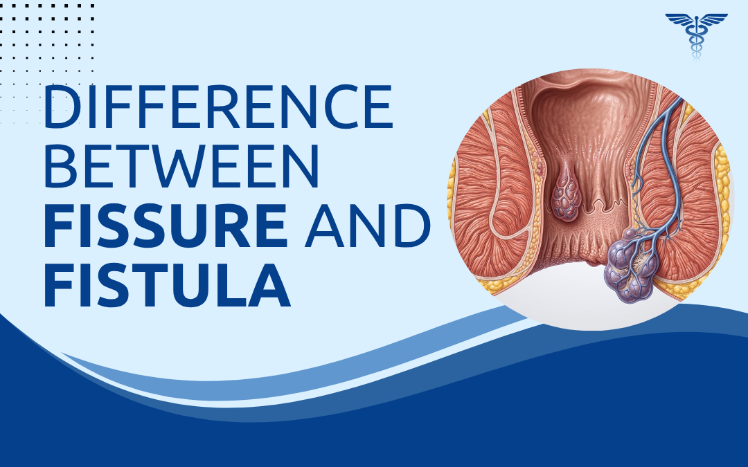 Difference Between Fissure and Fistula