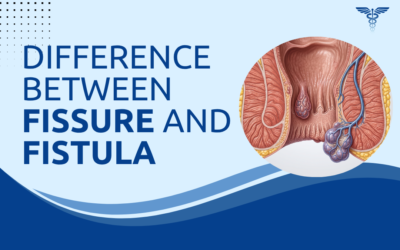 Difference Between Fissure and Fistula?
