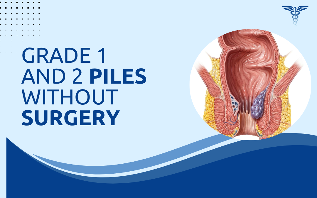 Grade 1 and 2 Piles Without Surgery
