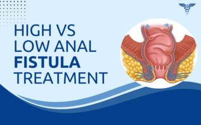 High vs Low Anal Fistula: What Is the Difference in Treatment?