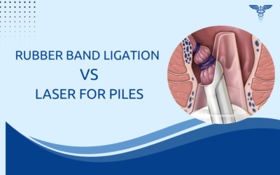 Rubber Band Ligation vs Laser for Piles