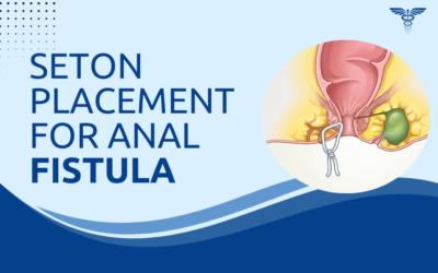 What Is Seton Placement for Anal Fistula?