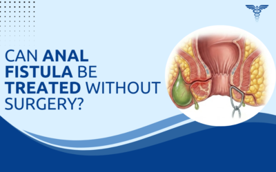 Can Anal Fistula Be Treated Without Surgery?