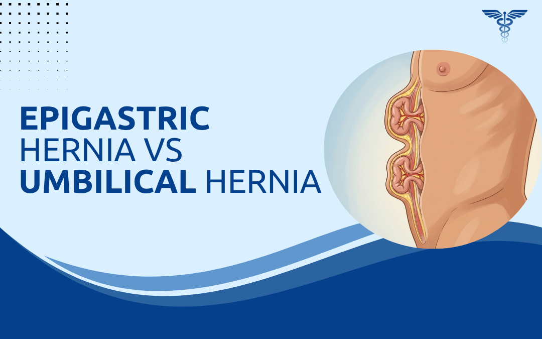 Epigastric Hernia vs Umbilical Hernia