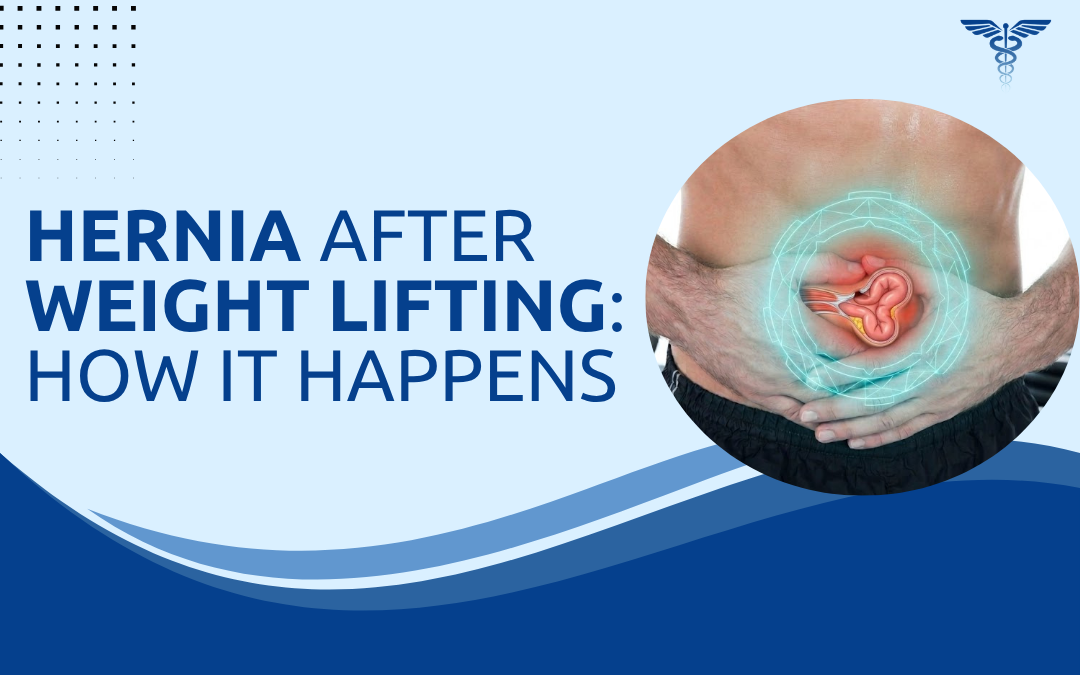 Hernia After Weight Lifting How It Happens