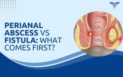 Perianal Abscess vs Fistula: What Comes First?