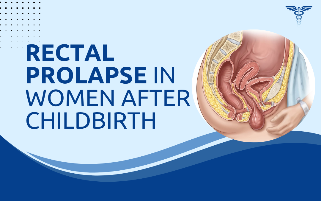 Rectal Prolapse in Women After Childbirth
