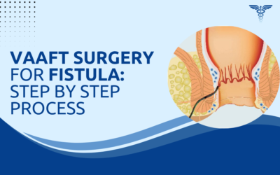 VAAFT Surgery for Fistula: Step by Step Process