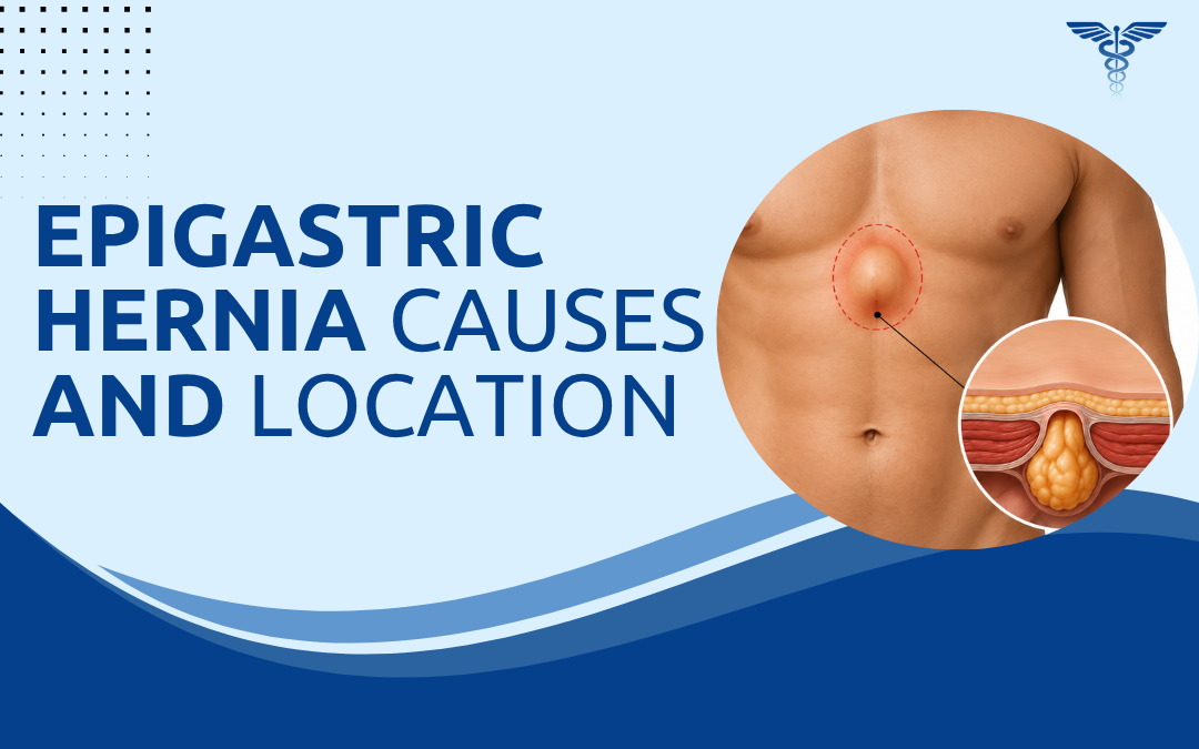 Epigastric Hernia Causes and Location