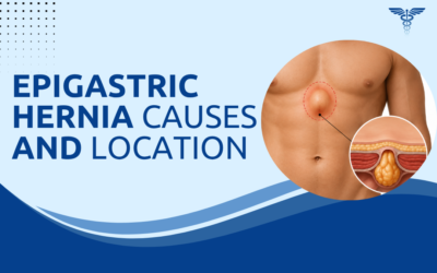 What Is an Epigastric Hernia and Where Does It Appear?