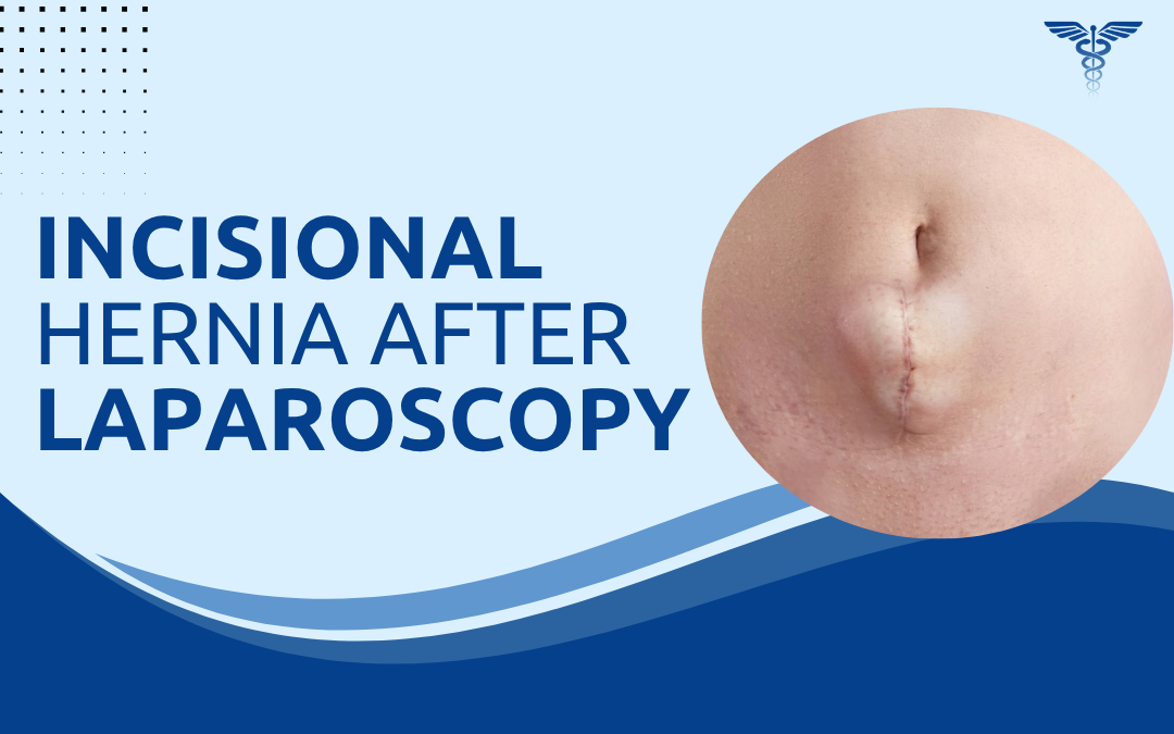 Incisional Hernia After Laparoscopy