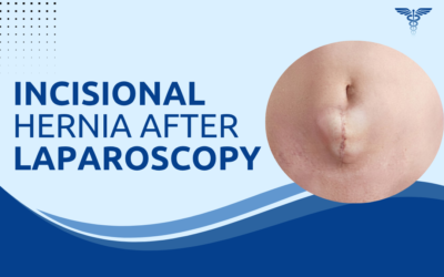 Incisional Hernia After Laparoscopic Surgery: How Common Is It?