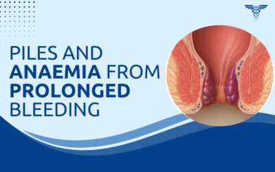 Can Piles Cause Anaemia From Prolonged Bleeding?