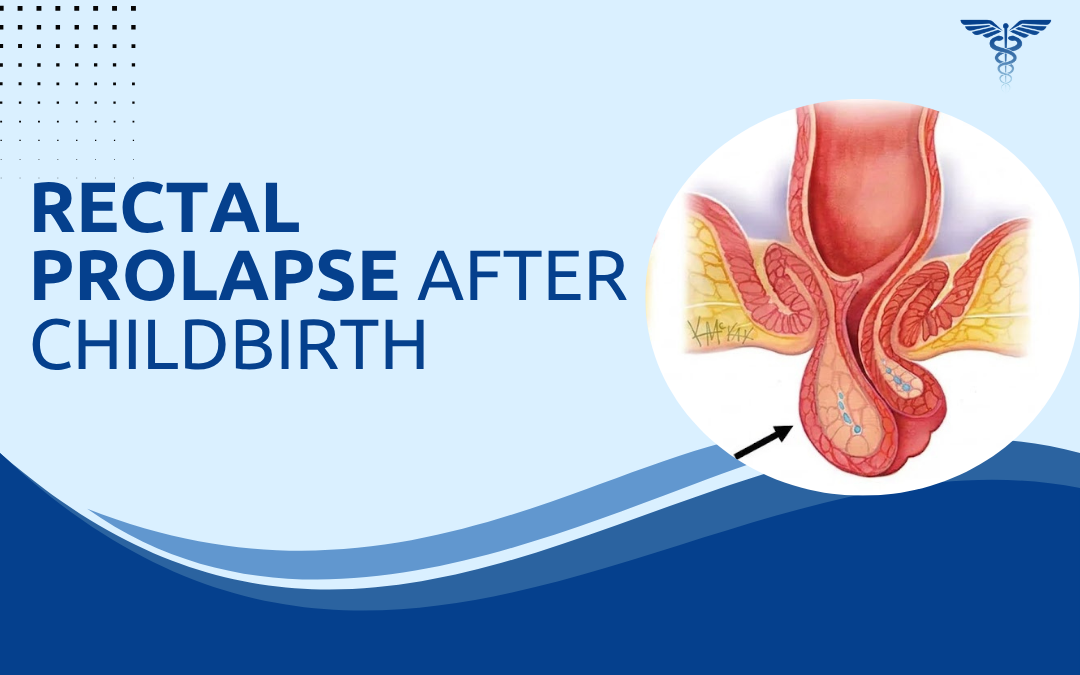 Rectal Prolapse After Childbirth