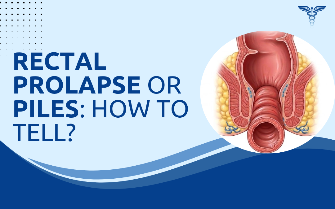 Rectal Prolapse or Piles How to Tell