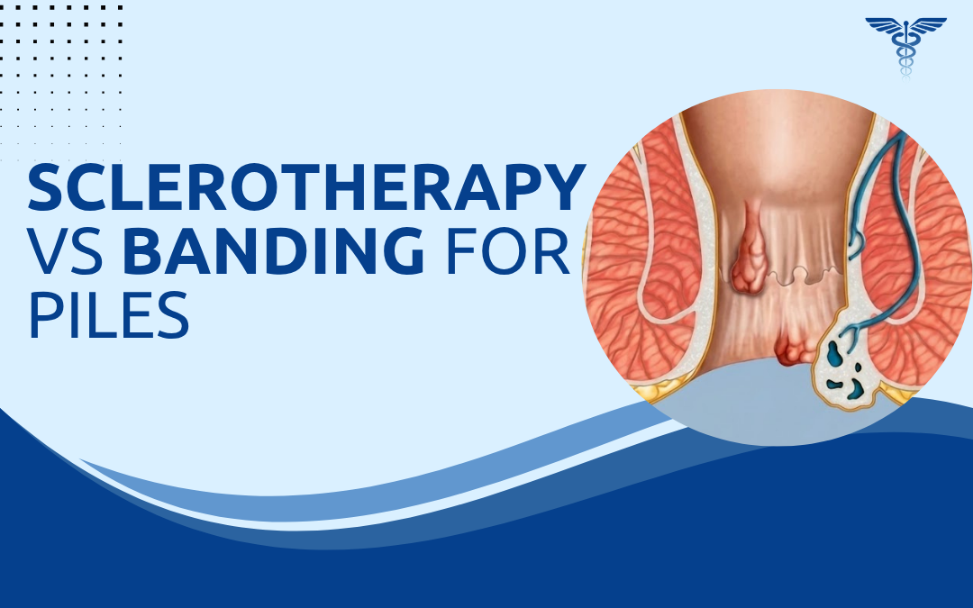 Sclerotherapy vs Banding for Piles