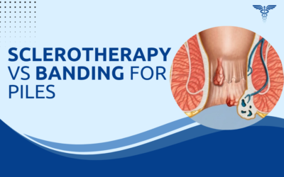Sclerotherapy vs Rubber Band Ligation for Piles: Which?