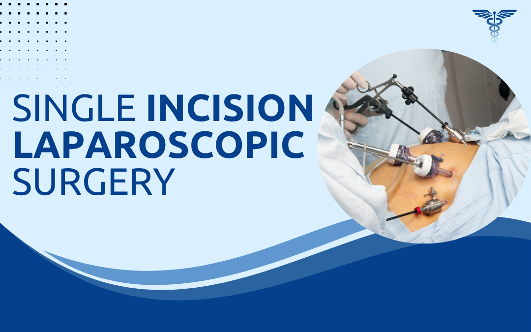 Single Incision Laparoscopic Surgery