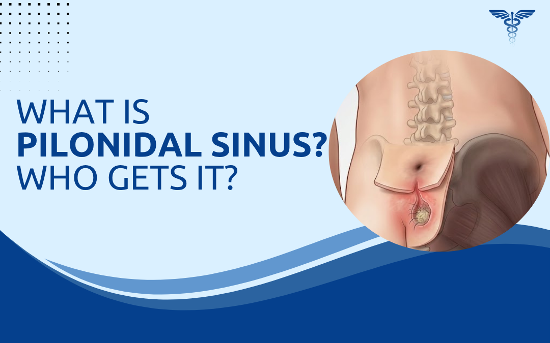 What Is Pilonidal Sinus Who Gets It