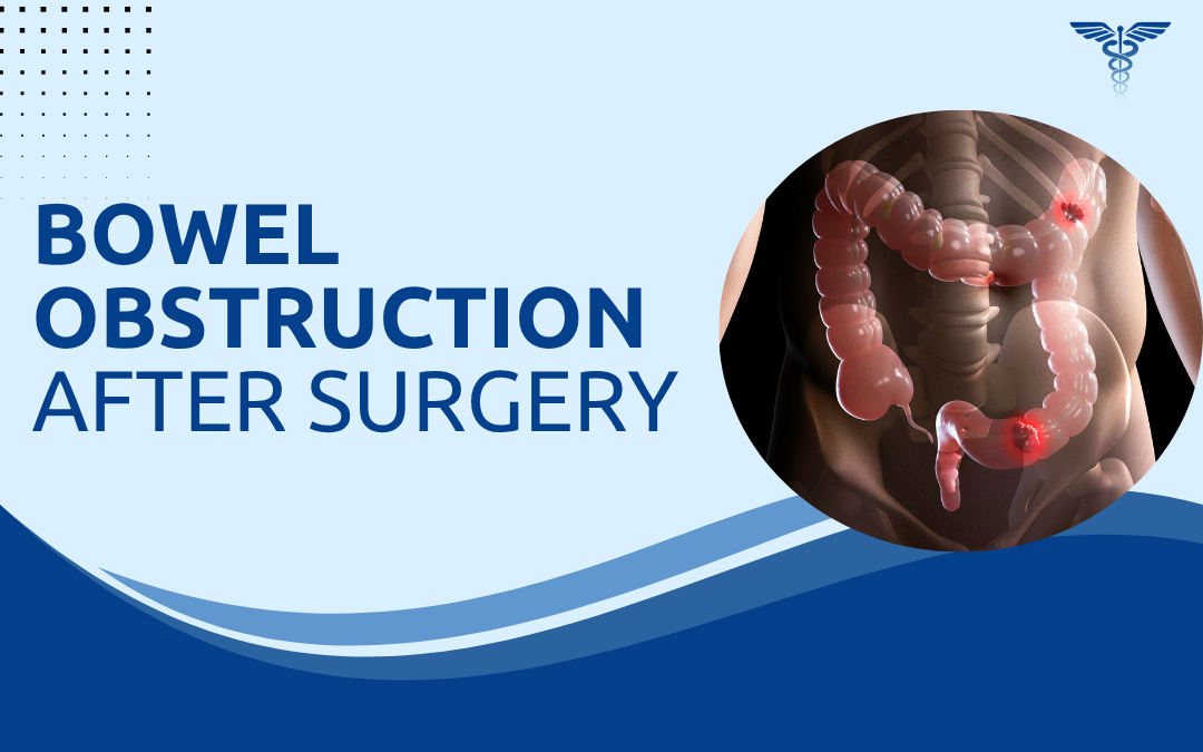 Bowel Obstruction After Surgery
