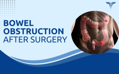 Can Post-Surgery Adhesions Cause Bowel Obstruction?