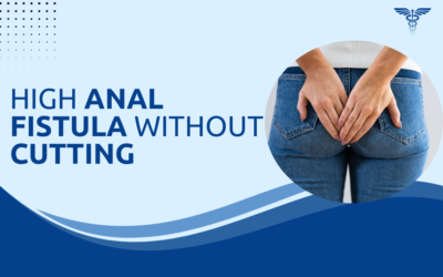 Can High Anal Fistula Be Treated Without Cutting?