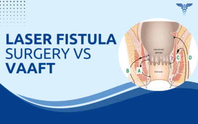 Laser Fistula Surgery vs VAAFT: Which Has Better Results?
