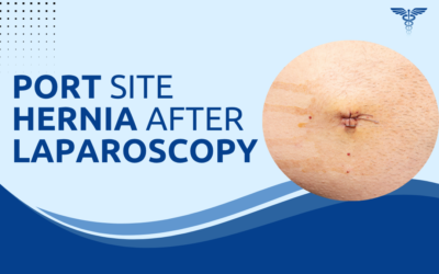 What Is a Port Site Hernia After Laparoscopy?
