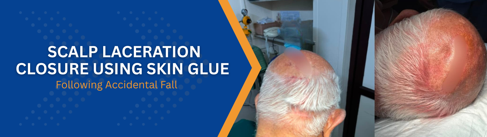 Scalp Laceration Closure Using Skin Glue Following Accidental Fall