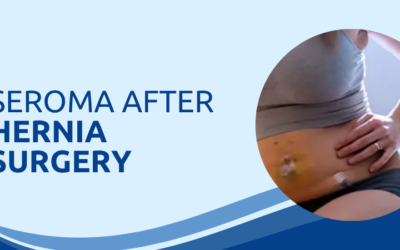 Seroma After Hernia Surgery: Causes, Symptoms and Treatment