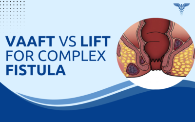 VAAFT vs LIFT: Which Is Better for Complex Fistula?